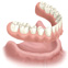 over denture