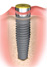 over denture