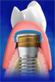 over denture
