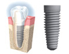 over denture
