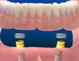 over denture